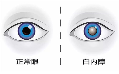 白內(nèi)障手術(shù)免費(fèi)政策2025新版:光明行動(dòng)新政策中符合條件老人可申請(qǐng)免費(fèi)白內(nèi)障手術(shù)!