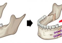 廣州正頜手術(shù)醫(yī)生周會喜簡介：20年經(jīng)驗，技術(shù)很出色！