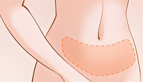 吸脂腹部區(qū)域