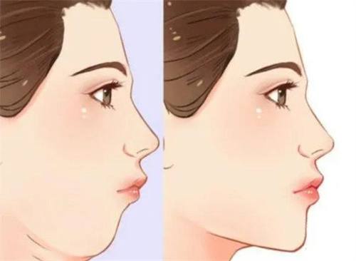 雙下巴抽脂前后對(duì)比側(cè)面動(dòng)畫(huà)圖