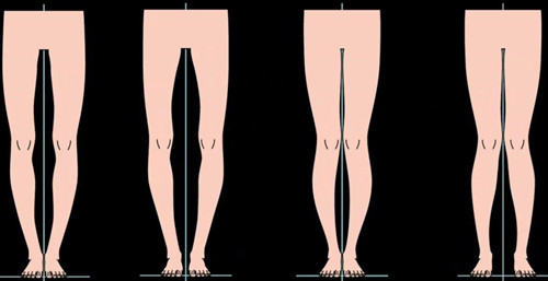 不同腿型卡通示意圖