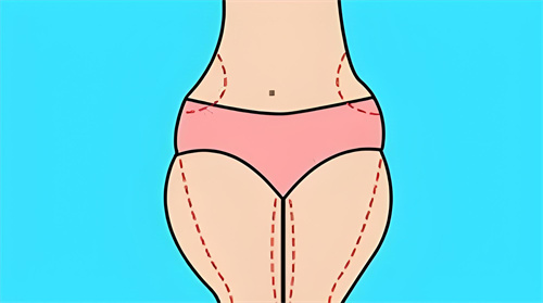 腿部吸脂手術(shù)吸脂部位動畫圖
