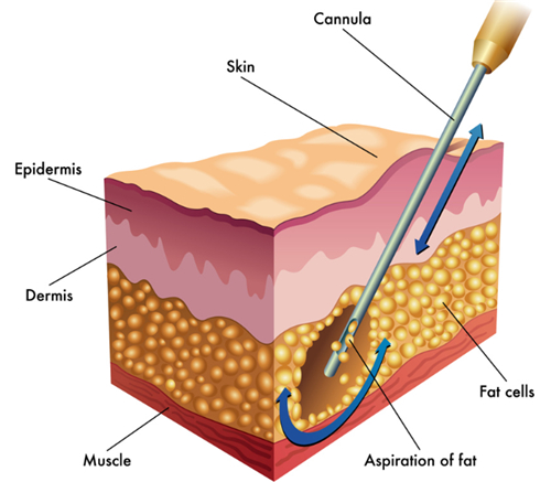 吸脂手術(shù)動(dòng)畫圖示 吸脂手術(shù)動(dòng)畫圖示