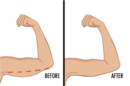 手臂吸脂對(duì)比圖 手臂吸脂對(duì)比圖