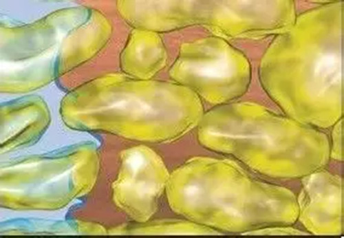 水動(dòng)力吸脂微觀示意圖 水動(dòng)力吸脂微觀示意圖