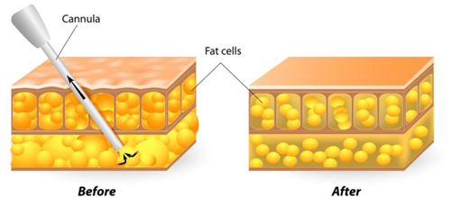 吸脂前后對比圖示