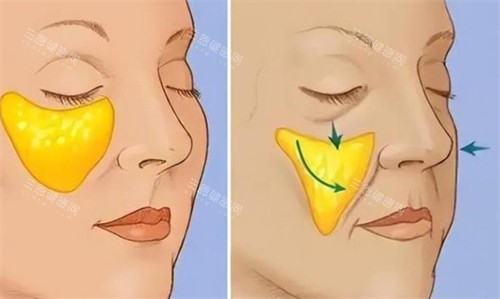 面部蘋果肌提升前后對(duì)比 面部蘋果肌提升前后對(duì)比