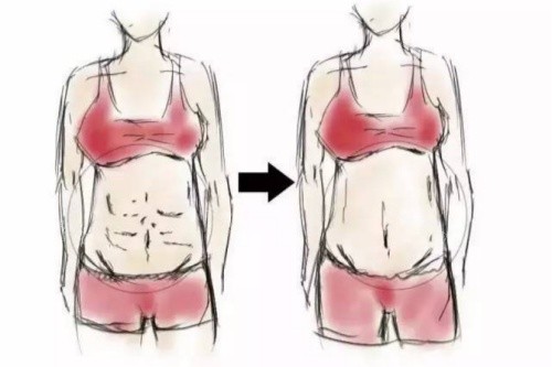腹壁成型術(shù)卡通對比圖