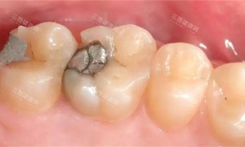 牙齒金屬補(bǔ)牙圖