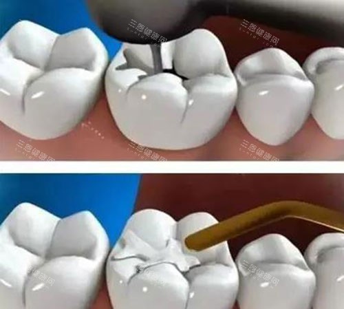 補(bǔ)牙過程示意圖