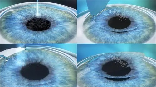 烏魯木齊**眼科個(gè)性化微飛秒手術(shù)過程圖