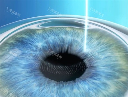 全激光近視手術(shù) 全激光近視手術(shù)