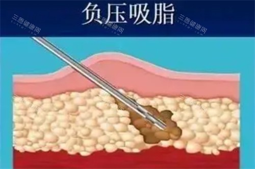 負(fù)壓吸脂