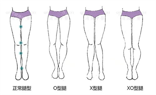 O型腿和X型腿對(duì)比圖