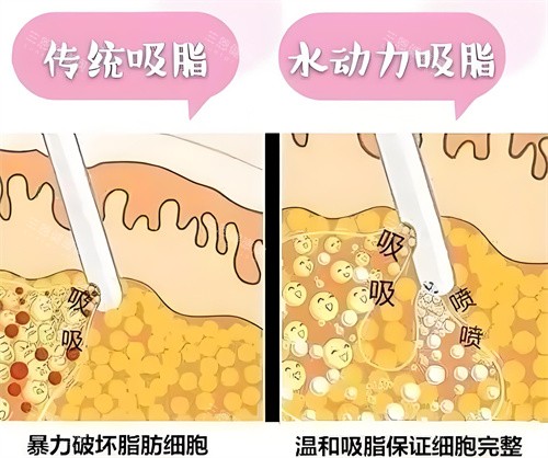 負(fù)壓吸脂和水動(dòng)力吸脂方式對(duì)比動(dòng)畫圖