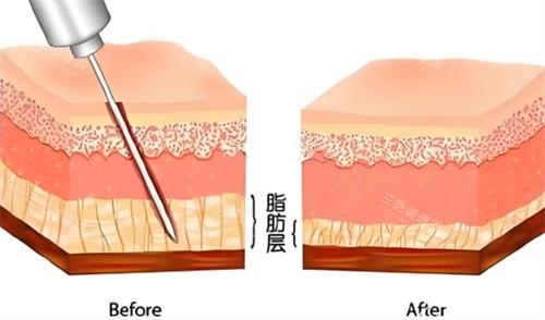 吸脂手術(shù)脂肪層對(duì)比