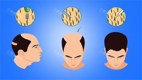 男性毛發(fā)移植對(duì)比動(dòng)畫(huà)圖