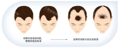 脫發(fā)步驟動(dòng)畫演示圖 脫發(fā)步驟動(dòng)畫演示圖