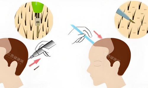 后枕部位取毛囊植發(fā)展示 后枕部位取毛囊植發(fā)展示