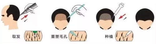 植發(fā)過程圖 植發(fā)過程圖
