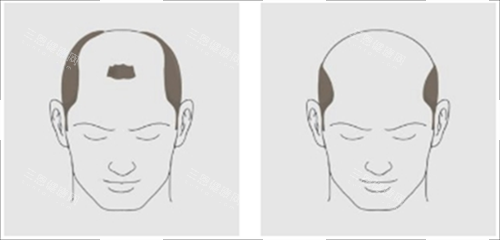 重度掉發(fā)素材 重度掉發(fā)素材