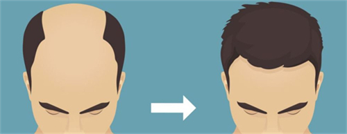 植發(fā)手術(shù)前后對比