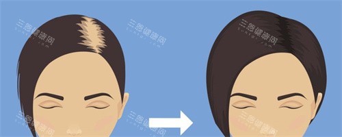 女性毛發(fā)移植對比動畫圖