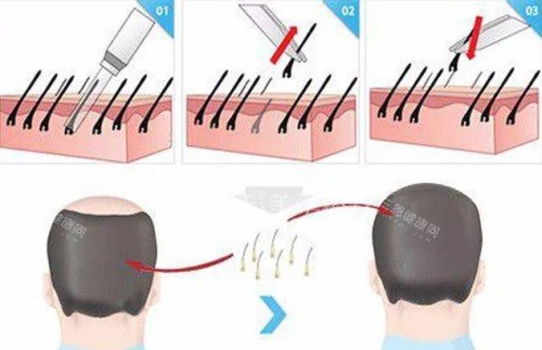 植發(fā)對比圖 植發(fā)對比圖