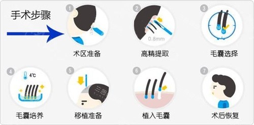 毛發(fā)移植手術步驟動畫演示圖 毛發(fā)移植手術步驟動畫演示圖