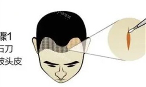 植發(fā)際線 植發(fā)際線