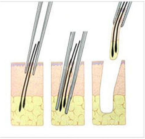 提取毛囊動畫圖