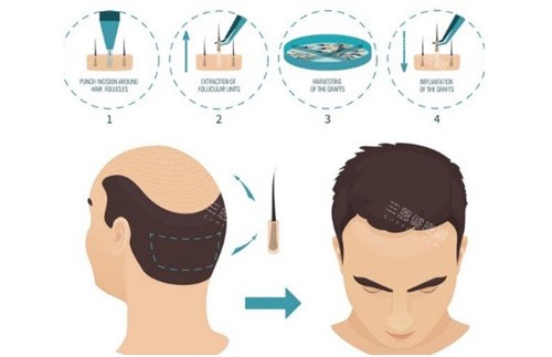 不同的植發(fā)類型