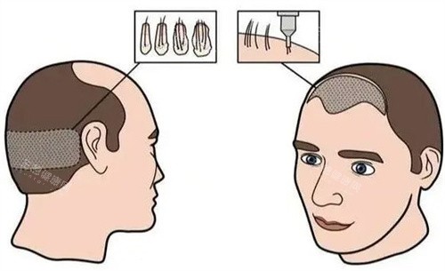 發(fā)際線植發(fā)