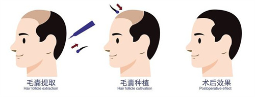 毛囊移植術前術后成效動畫圖 毛囊移植術前術后成效動畫圖