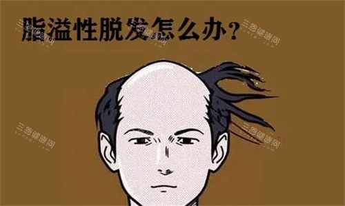 脂溢性脫發(fā)怎么辦 脂溢性脫發(fā)怎么辦