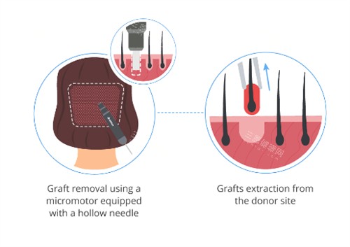 毛發(fā)移植過(guò)程圖解