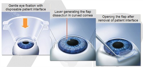 2025愛(ài)爾眼科收費(fèi)價(jià)目表出爐！近視手術(shù)8000元起，白內(nèi)障、OK鏡、斜視手術(shù)等價(jià)格透明