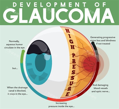 青光眼的眼睛結(jié)構(gòu)圖