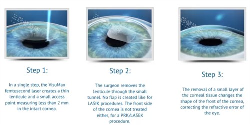 眼睛近視手術的過程