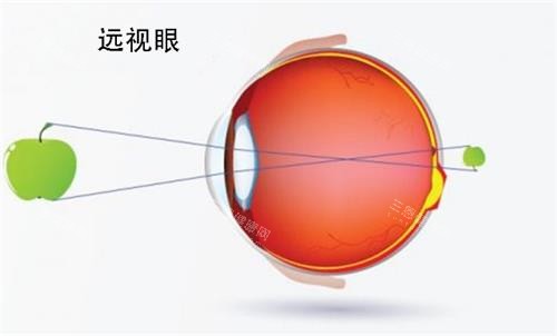 遠視眼睛的視力