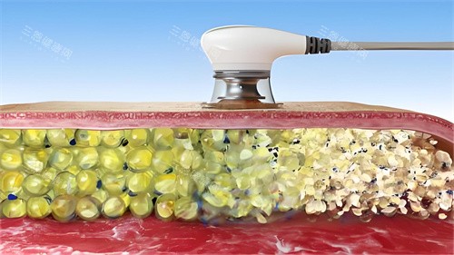 超聲波溶脂過(guò)程演示圖