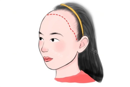 女型發(fā)際線種植卡通 女型發(fā)際線種植卡通