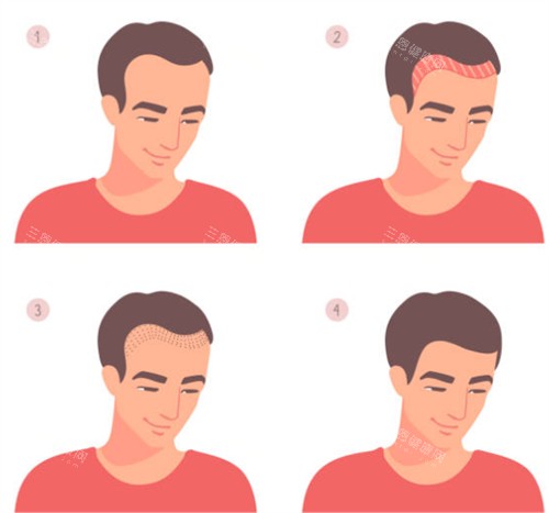 發(fā)際線植發(fā)前后圖解 發(fā)際線植發(fā)前后圖解