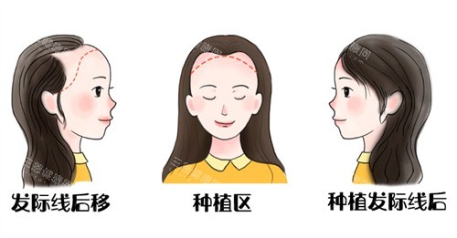 發(fā)際線后遺種植前后 發(fā)際線后遺種植前后