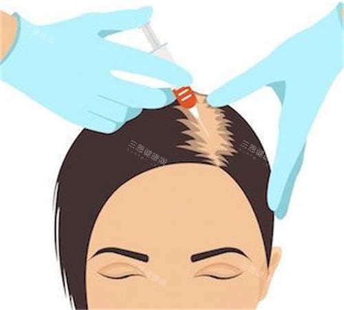 脫發(fā)PRP注射治療過程圖解