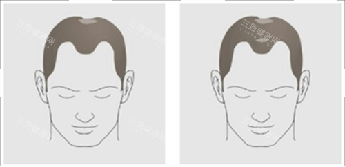 發(fā)際線及頭頂頭發(fā)脫落素材