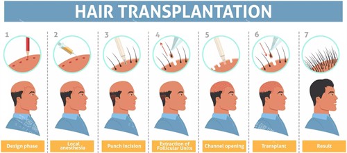 頭發(fā)種植流程圖一覽