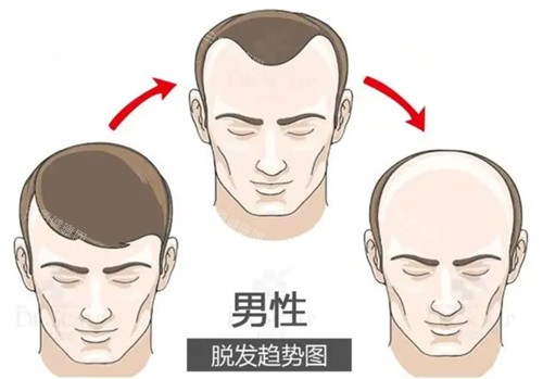 脫發(fā)趨勢(shì)圖