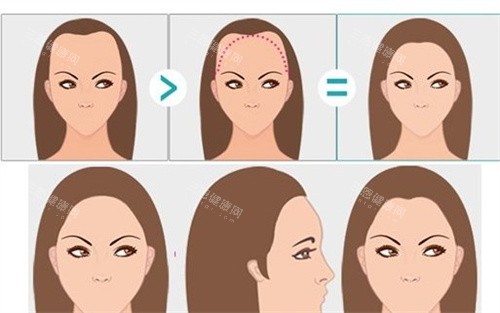 女性m型發(fā)際線卡通圖