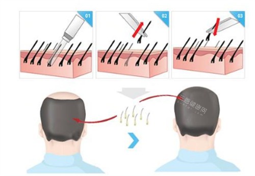 微針植發(fā)過程步驟